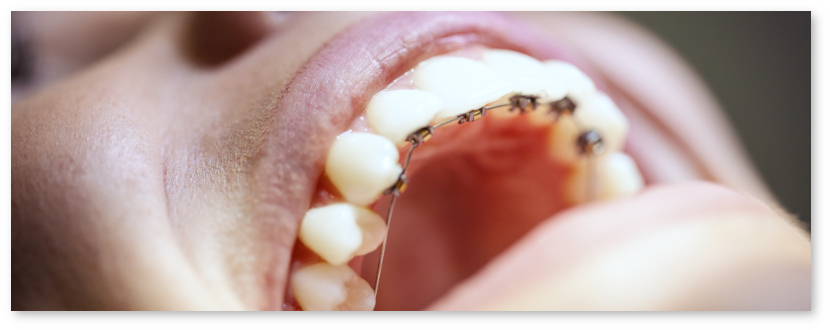 orthodontie linguale paris 17